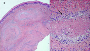 A, Panoramic image showing granulomas located in the deep dermis (hematoxylin-eosin, original magnification ×20). B, Detail of the same image showing granulomas composed of palisaded histiocytes (arrow) arranged around a central eosinophilic zone corresponding to fibrin (asterisk) (hematoxylin-eosin, original magnification ×100).