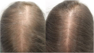 A, Woman (aged 33 years) with female pattern hair loss before starting oral minoxidil treatment (1 mg/d). B, Patient after 12 months of treatment.