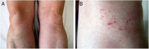 A, Brownish erythematous papules on both knees. B, Detailed image showing lichenoid lesions, some arranged linearly, on the left knee.