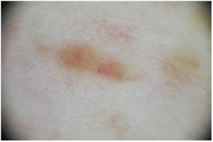 Dermoscopic image showing an area of homogeneous yellow-orange coloration within which linear vessels are evident. (A full-color version of this image can be found in the web version of this article.)