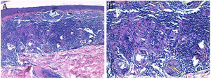 Histological images. A, Non-necrotizing granulomatous infiltrate in the superficial dermis (hematoxylin-eosin, original magnification ×10). B, Epithelioid histiocytes and birefringent crystalline material phagocytosed by multinucleated giant cells (hematoxylin-eosin, original magnification ×20).