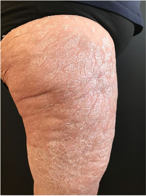 Scaly plaques especially notable on the anterior and lateral regions of both thighs.