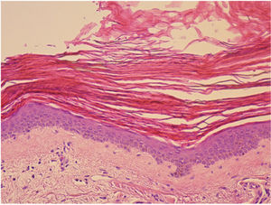 Histopathology of one of the lesions. Compact orthokeratotic hyperkeratosis, thinning of the granulomatous layer, and mild spongiosis can be observed. Mild lymphocytic infiltrate in the papillary dermis, with no other dermal abnormalities (hematoxylin–eosin, x20).