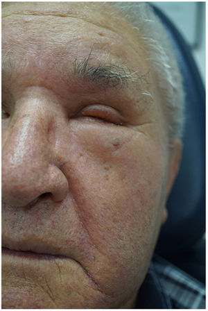 Facial pitting erythematous edema, predominantly on the left side.