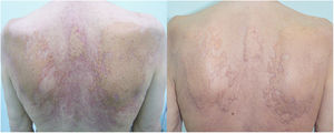 Xanthoma-like plaques on trunk, that had composed with the accumulation of yellow-orange papules on an erythematous background, and erythematous papules. Phototherapy resulted with healing of the erythematous papules, erosions and thinning of the yellow-orange plaques.
