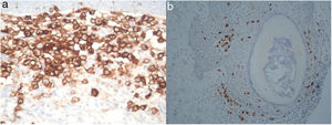 Immunohistochemistry showed CD1a (3a) and CD207 (3b) expression by the cells with eosinophilic cytoplasm and grooved or lobular nucleus.