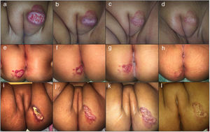 Clinical photographs of a 7-month-old girl with a mixed focal ulcerated IH of the major labia and two 4-month-old girls with a superficial focal ulcerated IH of the buttocks treated with oral atenolol showing changes in the color, size and wound closure at baseline (a,e, i), 2 weeks (b,f,j), 4 months (c,g,k), and 6 months (d,h,l).