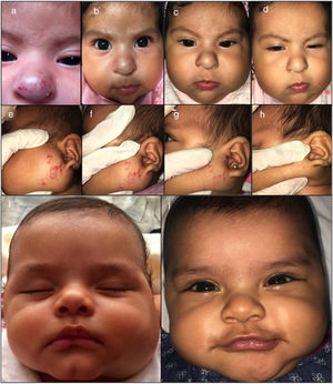 Clinical photographs of a 2-month-old girl with a mixed nasal IH and a 4-month-old girl with a mixed parotid IH treated with oral atenolol showing changes in size at baseline (a,e,i), 1 month (b,f) 2 months (c,g) and 4 months (d,h,j).