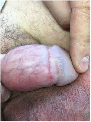 Erythematous-violaceous linear lesion around the penis.