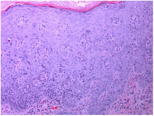 Epidermis with irregular acanthosis, hyperkeratosis, hypergranulosis, and squamous cells. Dyskeratosis, hyperchromatic nuclei, and multiple nuclei can be observed. Cellular atypia is observed throughout the thickness of the epidermis (hematoxylin-eosin, original magnification, ×200).