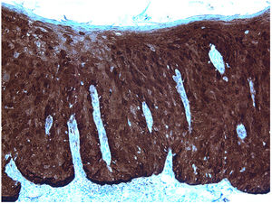 p16 immunohistochemistry yields intensely positive results in the cytoplasm and nuclei of keratinocytes throughout the thickness of the epidermis (p16 immunohistochemistry, ×200).