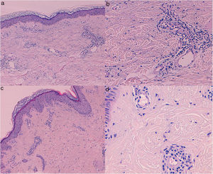 Skin biopsies (hematoxylin-eosin) from patients 1 (A, B) and 2 (C, D). A, C (×40), Dilation of superficial dermal vessels, with mild dermal edema and perivascular inflammatory infiltrate. Note the absence of vasculitis, capillary proliferation, and erythrocytic extravasation (×200). B, D, Endothelial cells projecting toward the vascular compartment, together with perivascular infiltrate.