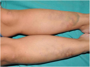 Extensive purpuric lesion on the anterior aspect of the middle and distal third of the left leg, and reticulated erythematous-violaceous lesions on the contralateral leg. Note the presence of 2 atrophic scars on the distal third of the right leg and on the left knee.