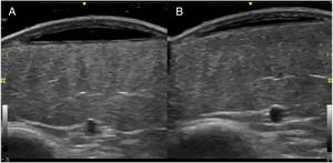 Ultrasound images of the left pretibial lesion (B-mode, 13-MHz probe). A, At the level of the ecchymotic area is an anechoic subcutaneous mass delimited by a thin pseudocapsule. B, Follow-up ultrasound 1 month later reveals a marked reduction in lesion thickness.