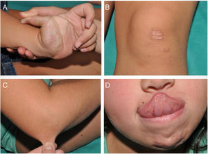 Characteristic clinical signs of classic Ehlers-Danlos syndrome. A, Joint hypermobility with hyperextension of the fingers. B, Atrophic scars with a cigarette-paper-like appearance. C, Skin hyperlaxity. D, Hyperextension of the tongue (Gorlin sign).