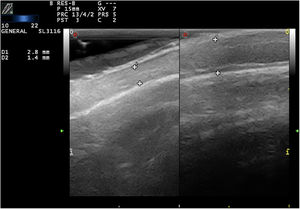 Ultrasound characteristics (10–22-MHz linear probe). Comparison of the alopecic plaque (left) with healthy scalp (right) from the same patient. Note the marked thinning of the scalp caused by loss of subcutaneous tissue.