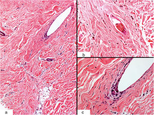 Histological characteristics (hematoxylin-eosin staining). A, Sclerotic dermis with dense collagen and a scar-like appearance (original magnification ×10). B, Detail of a broken hair follicle (original magnification ×40). C, Peripheral multinucleated giant cells (original magnification ×40).