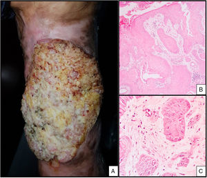 A, Ulcerated verrucous tumor on the left leg. B, Nests of squamous cells infiltrating the dermis (hematoxylin-eosin, original magnification ×10). C, Nuclear pleomorphism (hematoxylin-eosin, original magnification ×40).