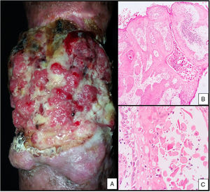 A, Ulcerated verrucous tumor on the right forearm. B, Well-differentiated infiltrating squamous cell carcinoma (hematoxylin-eosin, original magnification ×10). C, Mitosis, nuclear pleomorphism (hematoxylin-eosin, original magnification ×40).