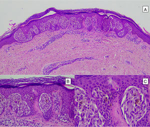 Intradermal Spitz nevus. Although most Spitz nevi are compound lesions, a small portion of them can be limited to the dermal-epidermal junction. Cytological features, however, are similar to those of compound Spitz nevi. A, Under low magnification, of note is an intradermal lesion composed of large blocks of spindle-shaped nevus cells. B and C, Under higher magnification, spindle cells can be observed without atypia and limited cytoplasmatic melanin pigment, as well as presence of Kamino bodies.