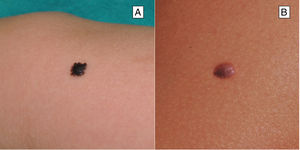 Clinical features of hyperpigmented Spitz nevus. A, Flat pigmented melanocytic lesion. B, Partially pigmented, well-delimited and dome-shaped melanocytic lesion.