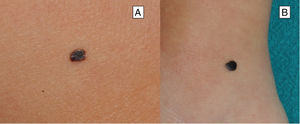 Clinical features of Reed nevus or pigmented spindle-cell nevus. A and B, Heavily pigmented melanocytic lesion, with a color between dark brown and black.