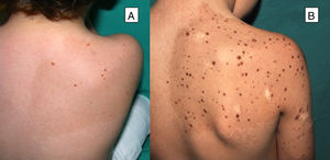 Multiple Spitz nevi. A and B, Multiple classic or hyperpigmented Spitz nevi, grouped on a cafe-au-lait spot distributed on the upper right quadrant of the back.