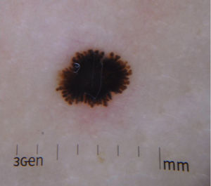 Dermatoscopic patterns of Reed nevus. Starburst pattern in which black, homogeneous, central pigmentation can be seen with regular radial projections at the periphery.