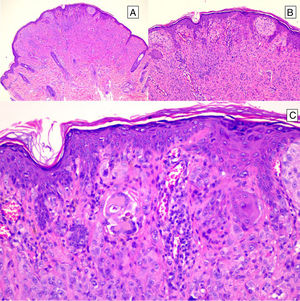Typical Spitz nevus.