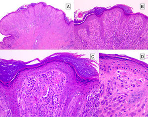 Typical Spitz nevus.