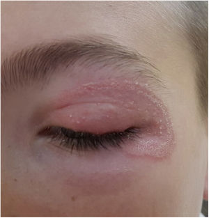 Tinea faciei on a 9-year-old boy. Note the inflammatory component, with micropustules.