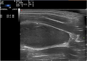 B-mode ultrasound image of a longitudinal section showing an oval hypoechogenic lesion beneath the sternocleidomastoid muscle.