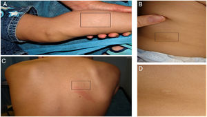 A, Skin lesions in Case 1. B, Skin lesions in Case 2. C, Skin lesions in Case 3. D, Detail of skin lesion in Case 2.