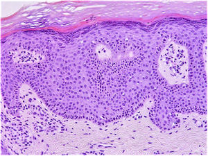 Skin biopsy with hyperkeratosis, acanthosis, and a palisade basal cell layer. A wide acellular area is focally evident just above the nuclei of the basal cell layer.