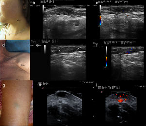 A, Clinical presentation of Case 1: a subcutaneous nodule of 10 mm in diameter in the left mandibular region with bluish discoloration of the overlying epidermis. B, Ultrasound examination in B-mode reveals a well-circumscribed, homogeneous hypoechoic lesion in the dermis, with hyperechoic dots without posterior acoustic shadowing. C, Ultrasound examination in color Doppler mode, revealing mild intralesional vascularization. D, Clinical presentation of Case 2: a subcutaneous mass of 20 mm in diameter in the right pectoral region, with no associated alterations in the epidermis. E, Ultrasound examination in color Doppler mode, revealing a well-circumscribed, homogeneous hypoechoic lesion in the subcutaneous cellular tissue. F, Ultrasound examination in color Doppler mode, revealing moderate intralesional vascularization. G, Clinical presentation of Case 3: a subcutaneous lesion of 1 cm in diameter with a slightly greenish-blue overlying epidermis. H, Ultrasound examination in B-mode revealing a well-circumscribed hypoechoic lesion in the dermis. I, Ultrasound examination in color Doppler mode, revealing prominent intralesional and perilesional vascularization.