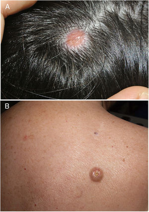 A, Nodule on the scalp. B, Nodule in the area of the right scapula.