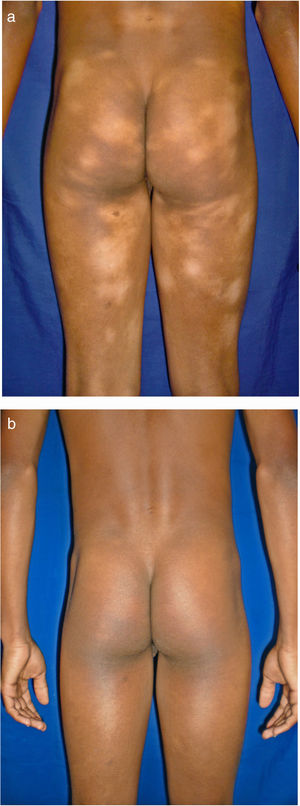 Hypopigmented macules in areas not exposed to sunlight. In this series, the hypopigmented variant was the most common form of mycosis fungoides. A, Before treatment. B, After psoralen-UV-A.