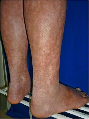 Capillaritis-type mycosis fungoides in an adolescent.