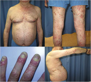 Erythematous plaques with thick, moderately infiltrated scale on the torso and upper and lower limbs. Periungual inflammation with ungual involvement in the form of trachyonychia, hyperkeratosis, oil drop, and onycholysis.