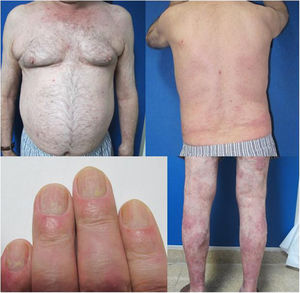 Residual erythematous patches on the torso and limbs. Major improvement of the nails with mild trachyonychia and some oil drop.