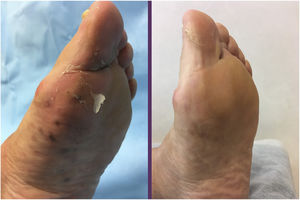 Multiple violaceous papules on the sole of the left foot, at the start and end of treatment.