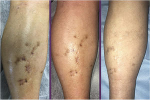 Evolution of the bluish papules and nodules on the right leg, before start of treatment with timolol gel, 0.5%, after 8 weeks, and after 3 months.