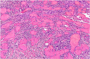 Proliferation of fusiform endothelial cells forming vascular spaces (hematoxylin–eosin, ×20).