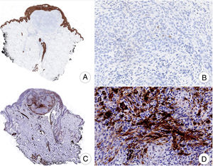 Absence of diffuse immune staining for AE1-AE3 (A, B) and focal immune staining for smooth muscle actin (C, D) (magnification: A, ×10; B, ×200; C, ×10; D, ×200).