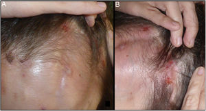 A and B, Crusted erosive lesions on an atrophic background in the region innervated by the V1 branch of the trigeminal nerve.