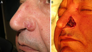 A, Recurrence of basal cell carcinoma in the left nasal ala. B, Postoperative defect after excision by Mohs micrographic surgery.