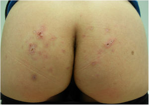 Improvement of skin lesions after treatment with albendazole.