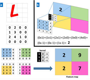A, Example of a convolution operation. A computer sees an image (L) as a 4×4 matrix of numbers. Each value of the input image is multiplied by a filter or kernel. Consequently, a new, reduced representation is obtained (a 2×2 feature map). B, Example of a specific operation for the values in the blue box.