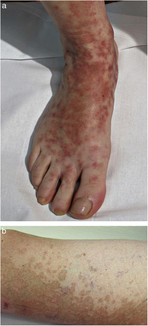 Schamberg disease. A, Orange-red macules that tend to coalesce, forming large plaques. B, Peripheral cayenne pepper spots.