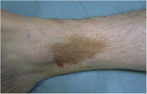 Lichen aureus. Solitary plaque comprising small coalescing yellow-orange macules on the leg.